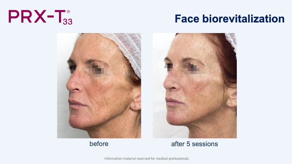 PRX-T33 Face Biorevitalization before → after 5 sessions
